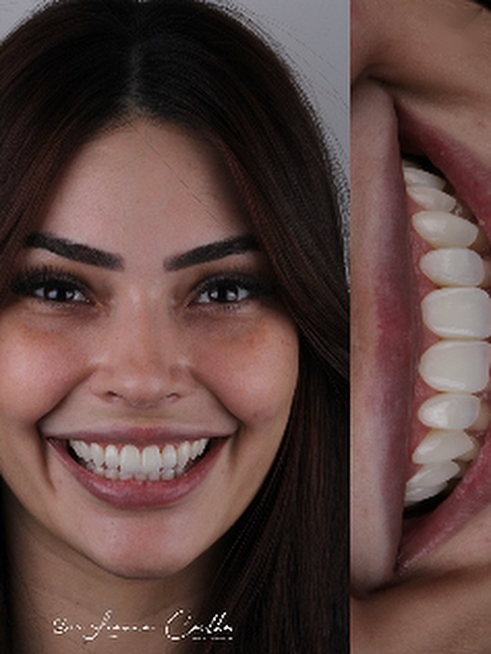 Caso de lentes de contacto dental, retrato y sonrisa