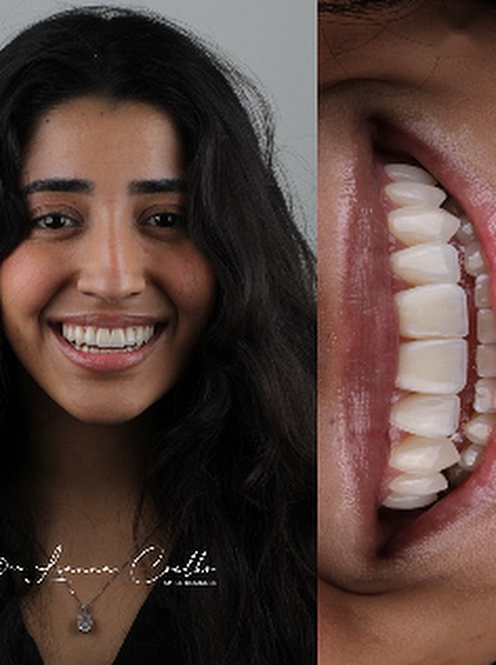 Caso de lentes de contacto dental, retrato y sonrisa