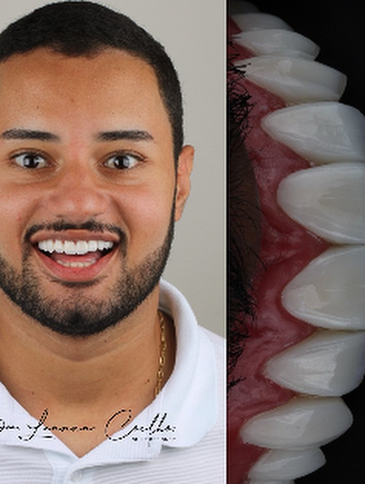 Caso de lentes de contacto dental, retrato y sonrisa