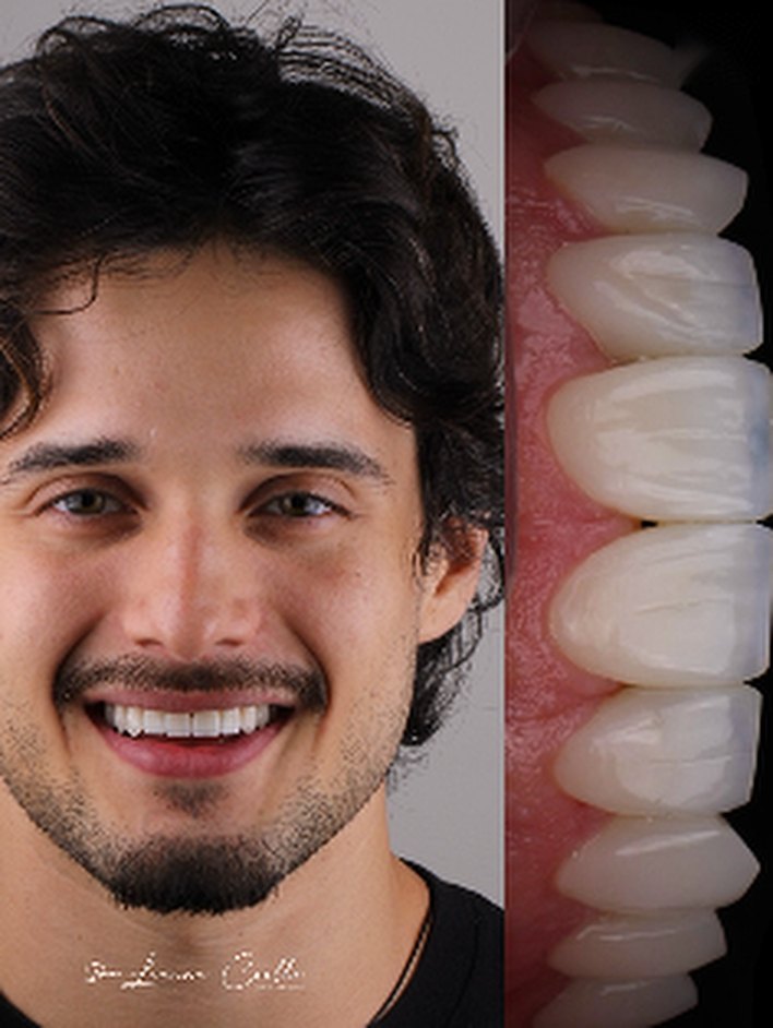 Caso de lentes de contacto dental, retrato y sonrisa