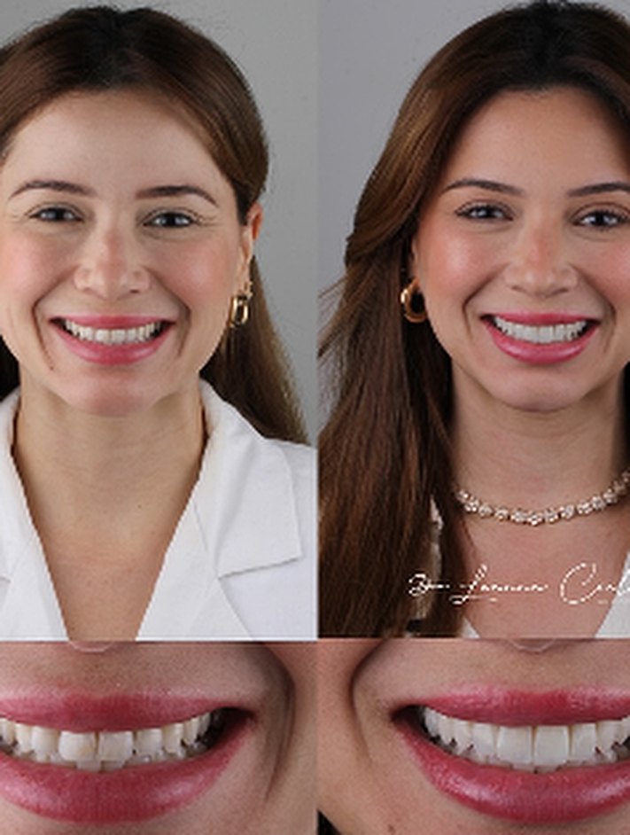 Caso de lentes de contacto dental, antes y después