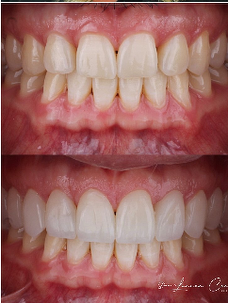 Caso de lentes de contacto dental, antes y después