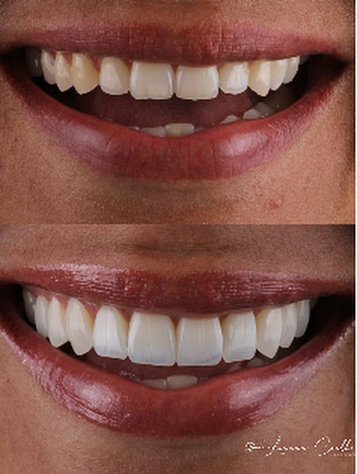 Caso de lentes de contacto dental, antes y después